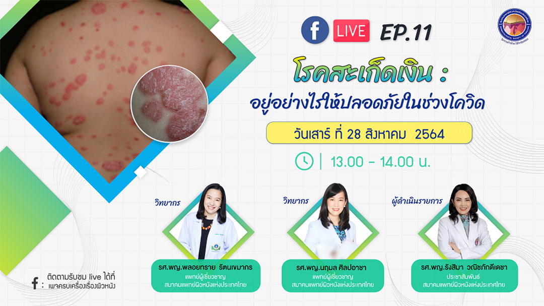 สมาคมแพทย์ผิวหนังเชิญรับชมเพจเฟซบุ๊ก “ครบเครื่องเรื่องผิวหนัง” ตอน โรคสะเก็ดเงิน “อยู่อย่างไรให้ปลอดภัยในช่วงโควิด”