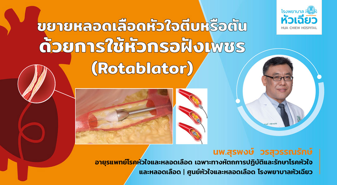 ขยายหลอดเลือดหัวใจตีบหรือตัน.. ด้วยการใช้หัวกรอฝังเพชร (Rotablator)